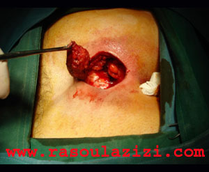 عمل جراحي درمان سينوس پيلونيدال - سينوس مويي - توده مو و چرک - آبسه - پيلونيدال ديمپل